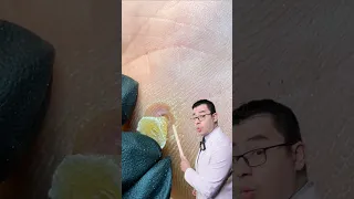 مسمار القدم 