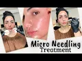 At-Home Microneedling Treatment - Full Guide Details