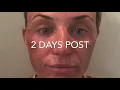 DOT LASER SKIN RESURFACING RECOVERY