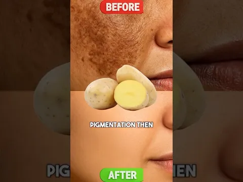 Potato & Multani Mitti Face Mask for Pigmentation, Dark Spots & Acne Scars 🥔
