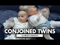 10 World s Most Famous Conjoined Twins