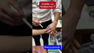  ทำไมข้อมือถึงบวมและเจ็บ โดยเฉพาะในผู้ที่ตั้งครรภ์หรือให้นมลูก 