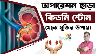 kidney stone treatment without medicine u0026 surgery 