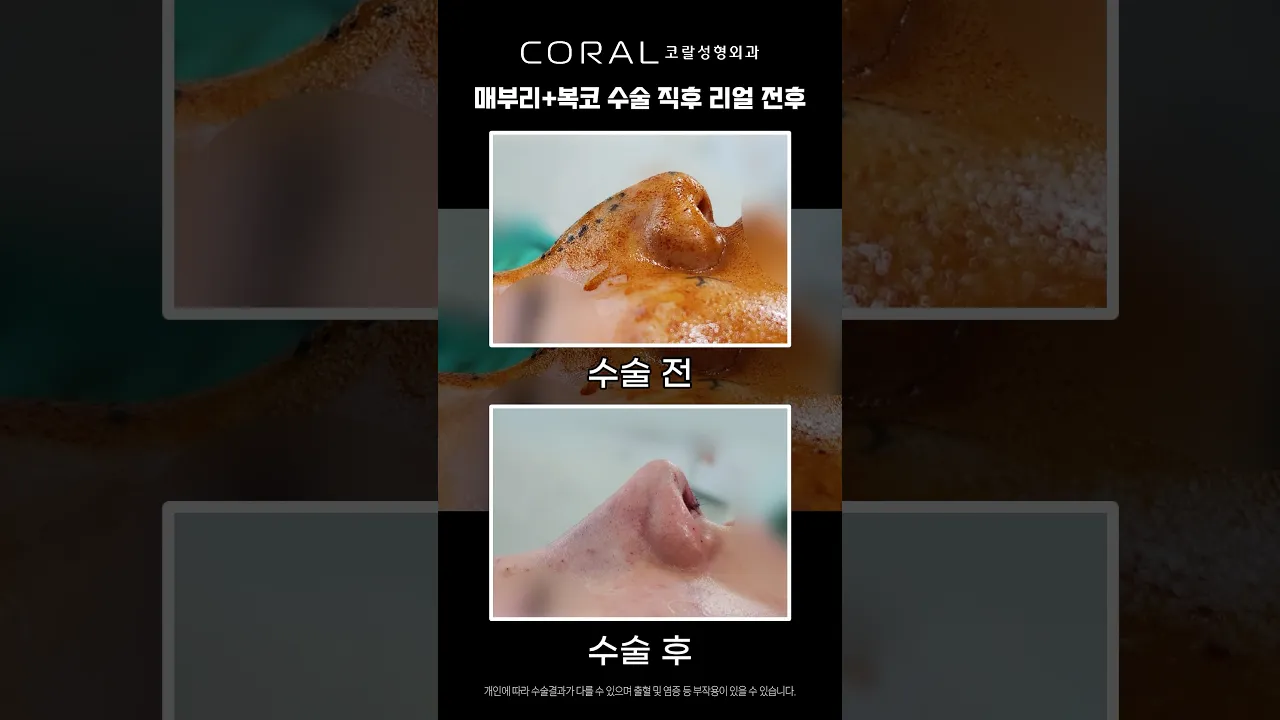 매부리에 복코까지... 수술 직후 미친 옆태 라인 B&A #shorts #매부리코 #복코