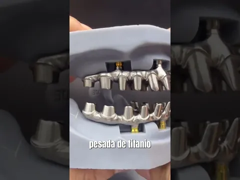 Nuevas prótesis híbridas sobre implantes TIPO TORONTO. Seguro que no la conoces TODAVÍA