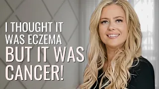 ITCHY Skin to Lymphoma - Miranda Hodgkin s Lymphoma The Patient Story