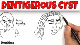 Dentigerous cyst - Pathogenesis Clinical Radiographic and Histopathologic features