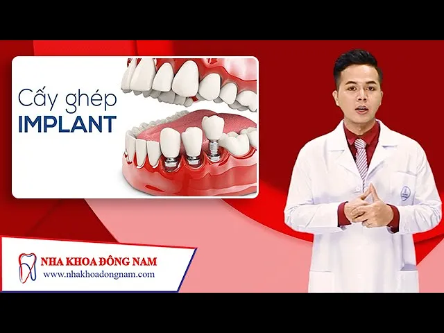 Outline Video Giải đáp các câu hỏi về phương pháp CẤY GHÉP RĂNG IMPLANT | NHA KHOA ĐÔNG NAM®