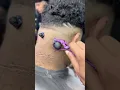 Removing the blackhead from the back of the neck