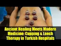Download Lagu Ancient Healing Meets Modern Medicine: Cupping \u0026 Leech Therapy in Turkish Hospitals