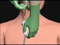 Download Lagu Central Line Placement by Cal Shipley, M.D.