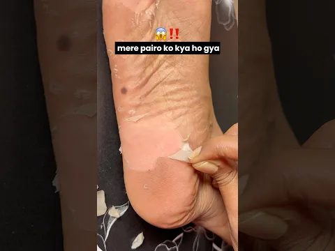What's wrong with my feet 😱/#foot #viralproducts #shorts