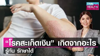 อาการของโรคสะเก็ดเงินมีอะไรบ้าง