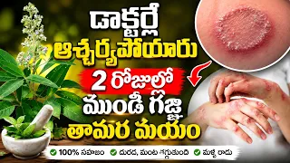 డాక్టర్లే ఆశ్చర్యపోయారు 2 రోజుల్లో గజ్జీ గజ్జిపుండ్లు తామర మాయం || gajji taggalante em chryali
