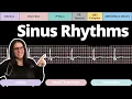 Sinus Rhythm on an EKG with Practice Qs Circulatory System and Disease NCLEX-RN Nurse Cheung