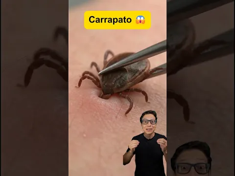 Retirar Carrapato 😱#medicina #medico #enfermagem #enfermeiro #enfermeira Mordida de Carrapato