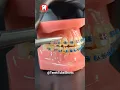 Triangle Elastics