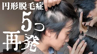 【悲報】円形脱毛症が５つも再発しました。