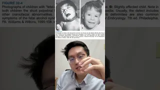  ฟีตแอลกอฮอลซินโดรม เกิดจากอะไร และส่งผลต่อทารกในครรภ์อย่างไร 