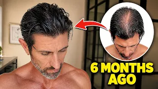 How I REVERSED My Hair Loss and Stopped Balding