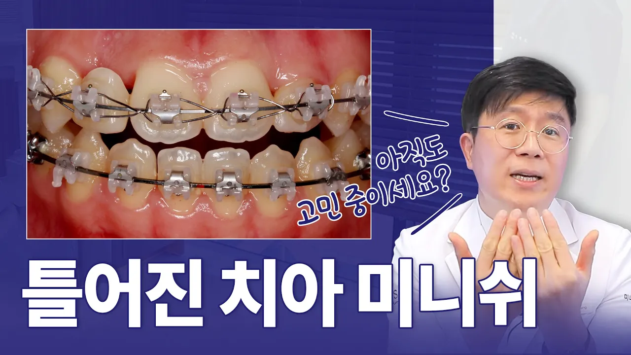 틀어진치아 교정이 고민된다면?ㅣ치료 선택이 중요