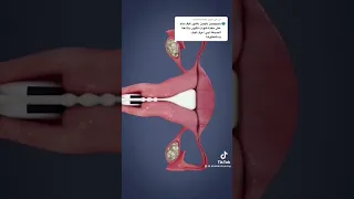 أشعة بالصبغة علي الرحم Learning Medical اشعة Reels How Shortvideo Shorts Shor Reel 