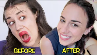 botox results after 1 week