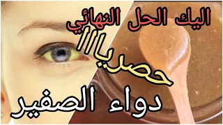 افضل طريقة لتخلص من مرض الصفير اليك الحل النهائي وصفة الصفير الجزائر 2022 