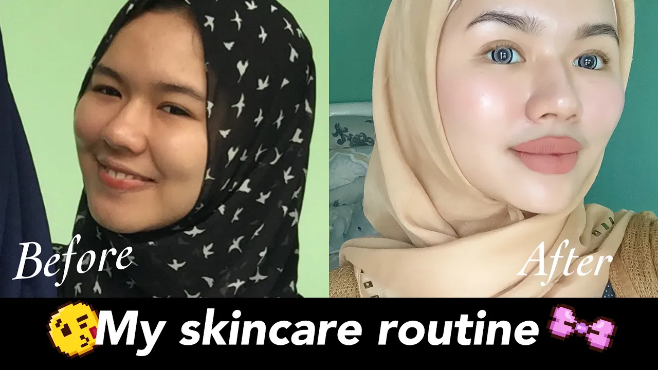 L'Oreal Paris Revitalift 1,5% Hyaluronic Acid Serum on Acne Prone Skin Review | Kiara Leswara