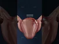 What does stage 4 endometriosis really look like inside the body Explore gynecology in 3D