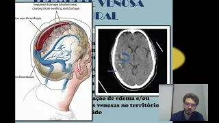 Aula - Trombose Venosa Cerebral - Graduação