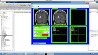 Image Compression Brain Image using Matlab