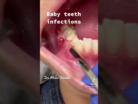 Dental Fistula, baby teeth infection #video #trending #tiktok #viral #shorts #youtubeshorts #shorts