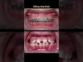 Download Lagu Braces process - Sparse teeth