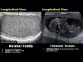 Scrotal Ultrasound Normal Vs Abnormal Image Appearances Scrotum Testis Epididymis USG Scan