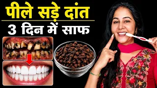 लौंग में एक चीज मिलाकर लगाई, पीले सड़े दांत मोती जैसे सफेद हो गए | Teeth whitening at home