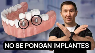 ¡No te pongas implantes hasta que sepas esto! Los dentistas no te dicen la verdad.