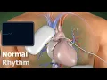 Learn how an AED works - 3D Animation