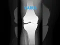 Varus - Valgus Deformities of the Knee on X-Ray