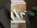 Download Lagu Sclerotherapy for Spider and Varicose Veins #Shorts