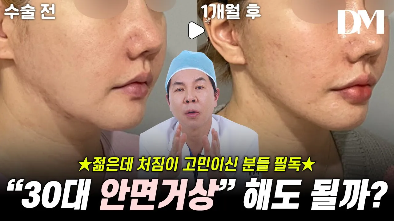 30대에 안면거상... 해도 괜찮을까? #안면거상 #리프팅 #중년안면거상