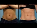 BodyTone Muscle Stimulation