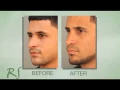 Rhinoplasty Experience of Dr Nassif s Patient Max