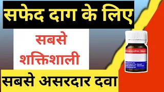 सफेद दाग की असरदार दवा, vitiligo treatment, safed daag ka ilaj, 