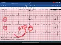 Lateral STEMI