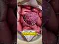 Download Lagu Craniotomy to Remove a Brain Tumor (3D Animation)