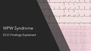 Wolff Parkinson White WPW Syndrome ECG 