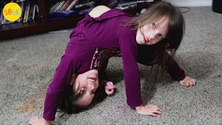 Conjoined Twins and Best Friends The Story of Callie and Carter