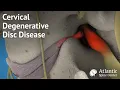 Cervical Degenerative Disc Disease