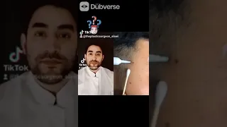مجرد مسح الشامة بسهولة باستخدام كريم سحري دندنها